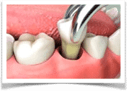 Tooth Extraction Okatie SC