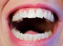 teeth whitening Bluffton SC