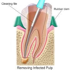root canal therapy hilton head island sc